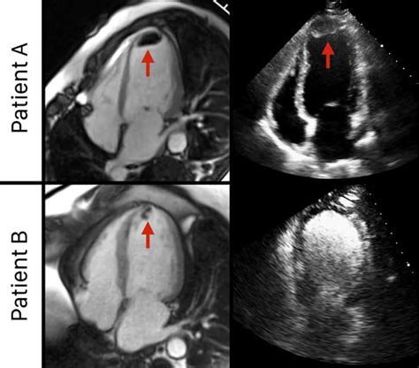 left ventricular thrombus diagnosis